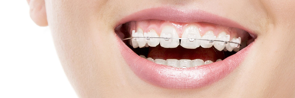 Burbank Invisible Orthodontics