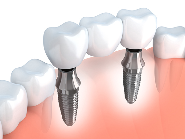 Cosmetic Dentist Procedures That Will Make You Smile