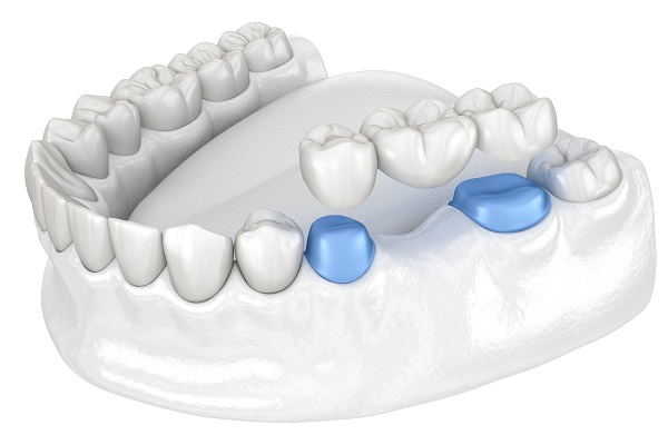 How A Dental Bridge Addresses A Missing Tooth