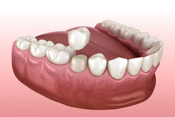 Dental Crown For A Tooth Restoration