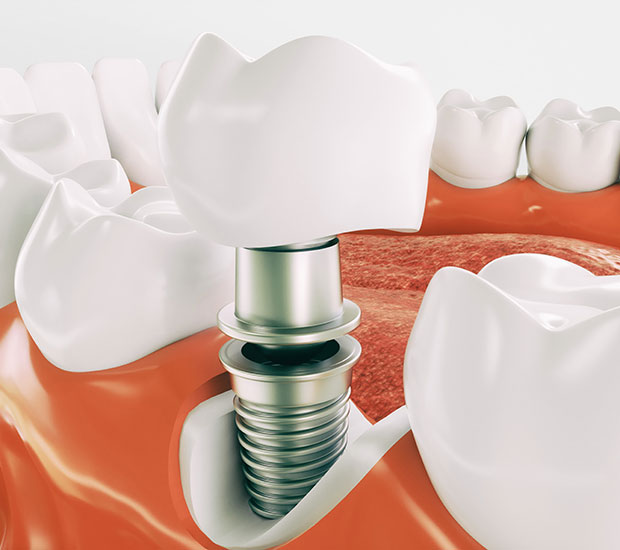 Burbank Dental Implant Restoration