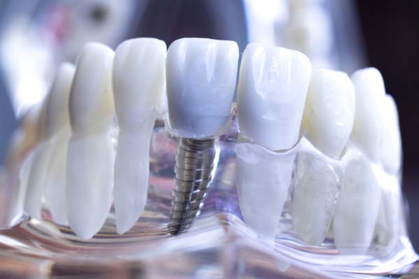 Dental Implants To Replace Missing Teeth