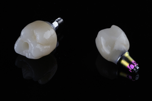 Can My Dentist Place Multiple Implants In One Appointment?