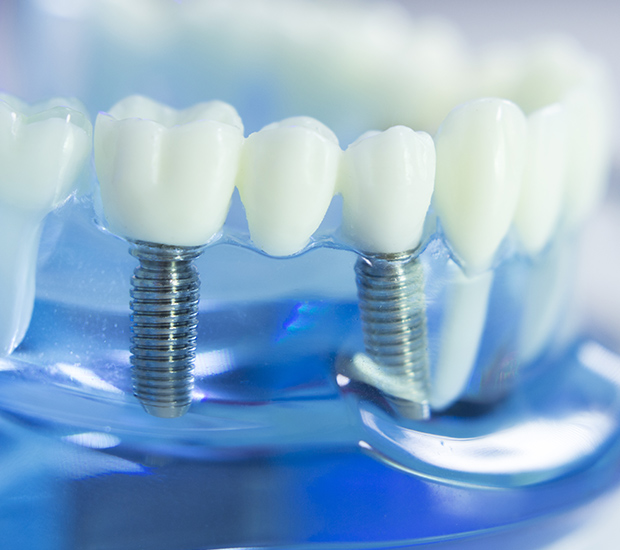 Burbank Dental Implants