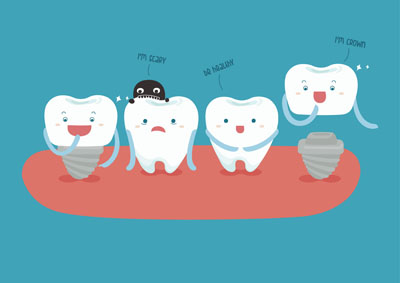 Dental Implants