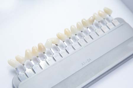 Dental Veneers