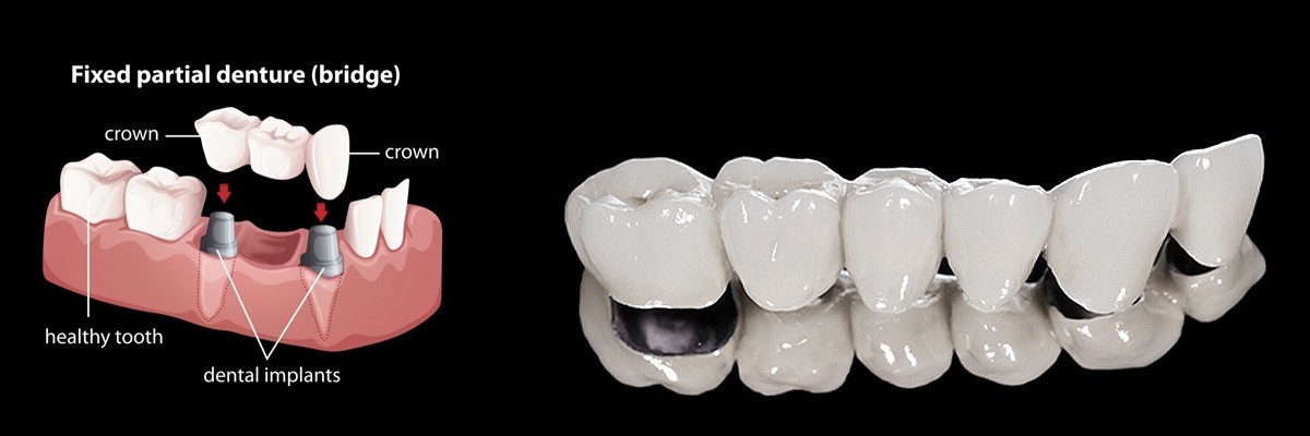 Burbank Dentures
