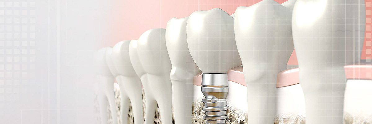 Burbank Implant Dentist