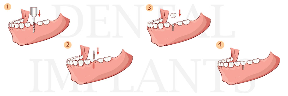 Burbank The Difference Between Dental Implants and Mini Dental Implants