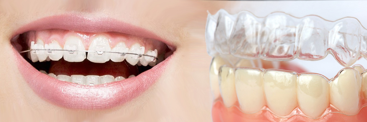Burbank Invisalign vs Traditional Braces