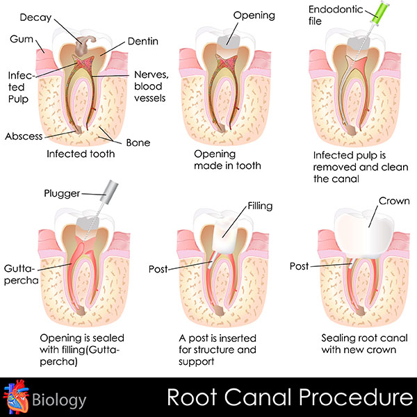 Root Canal Treatment Burbank, CA