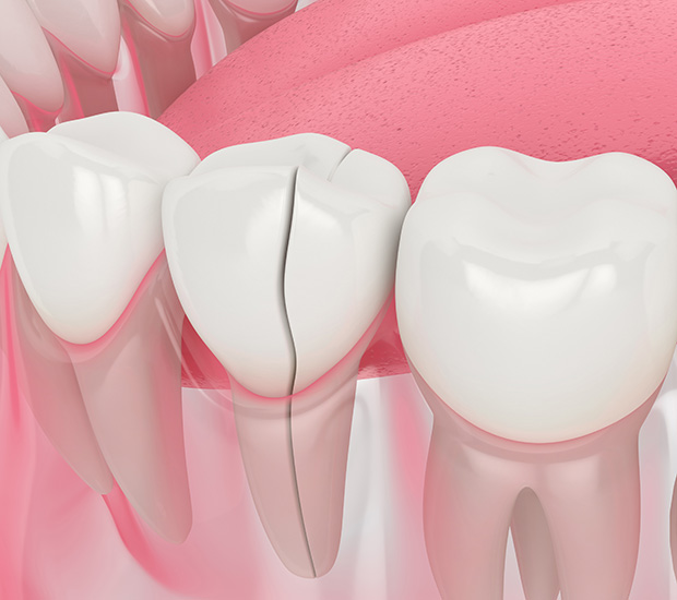 Burbank Types of Dental Root Fractures