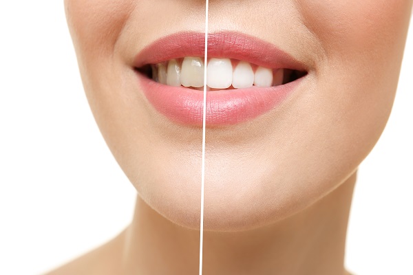 How Zoom Teeth Whitening Uses Light